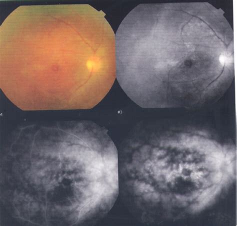 Retinopathy Associated With Interferon Therapy In Patients With Hepatitis C Virus