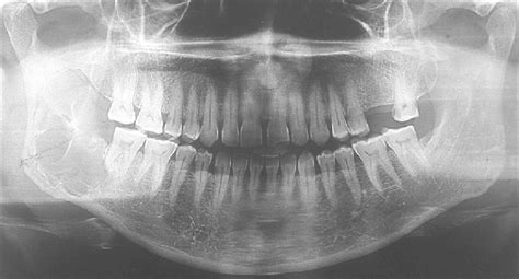 Orthopantamogram Showing A Unilateral Diffuse Multilocular Radiolucency