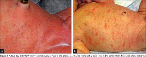 Figure 3 From Diagnostic Dilemmas Of A Herpes Like Rash In Healthy