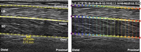 A Example Ultrasound Image Of Lateral Gastrocnemius And Soleus