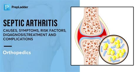 Septic Arthritis Causes Symptoms Risk Factors Diagnosis Treatment And Complications