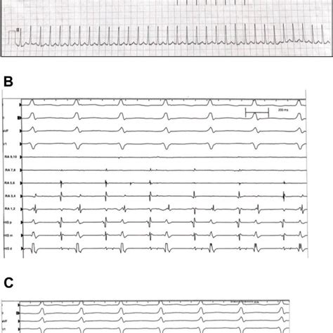 A Twelve Lead Electrocardiogram Showing A Regular Narrow Complex