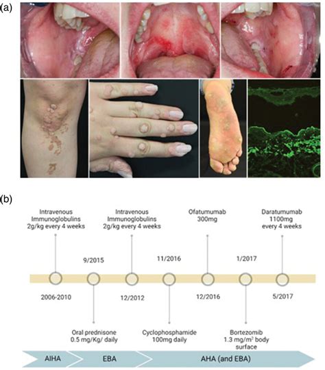 A Patient With Concomitant Epidermolysis Bullosa Acquisita Acquired