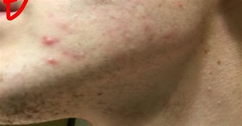 8 Months Post Accutane Album On Imgur