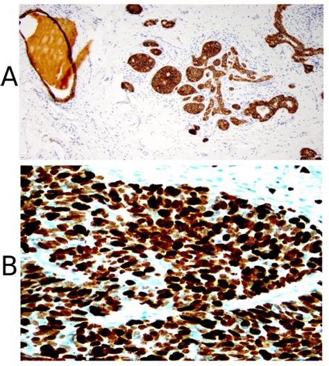 Immunohistochemical Staining Of The Carcinoma In Situ Lesion Of Patient