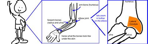 Kids Broken Elbow Lateral Condyle Fracture — Bone Talks