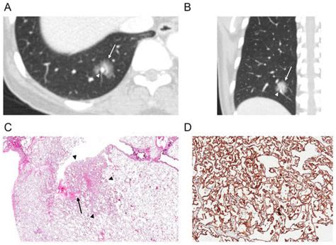 Diagnostics Free Full Text Solitary Pulmonary Capillary Hemangioma