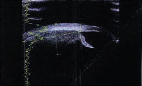 A 24-year-old man presented with conjunctival injection (a), pain, and... | Download Scientific ...