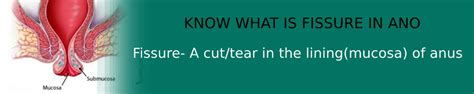 Anal Fissure