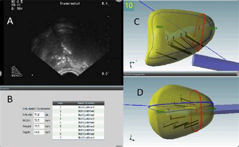 Transrectal Ultrasound Prostate Biopsy