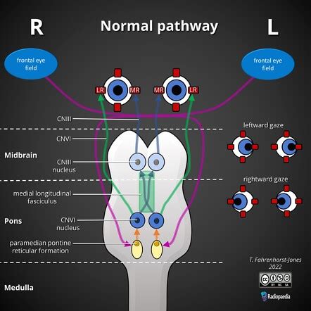 Medial longitudinal fasciculus | Radiology Reference Article | Radiopaedia.org