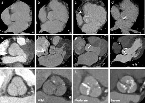 Aortic valve calcification severity. Images show different severities ...