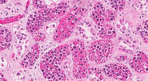 Intravascular Diffuse Large B Cell Lymphoma Ottawa Atlas Of Pathology