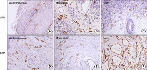 Lymphatic Vessel Density Lvd And Lymphatic Vessel Dilatation