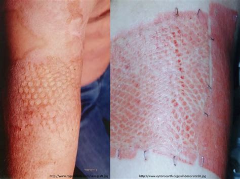 SKIN GRAFT | PPT