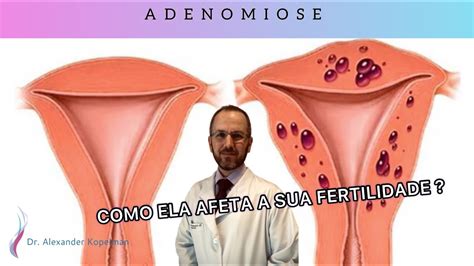 ADENOMIOSE QUAIS SÃO OS SINTOMAS TRATAMENTO E DIAGNÓSTICO COMO