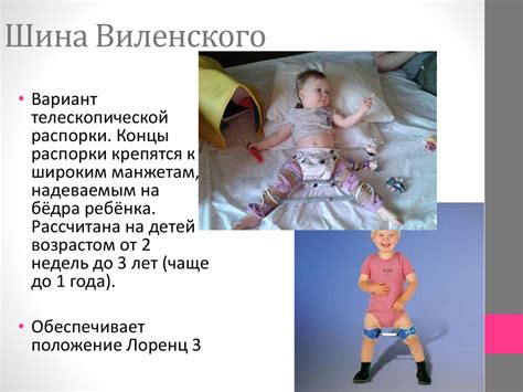 Врожденный вывих бедра (дисплазия тазобедренного сустава) - online ...