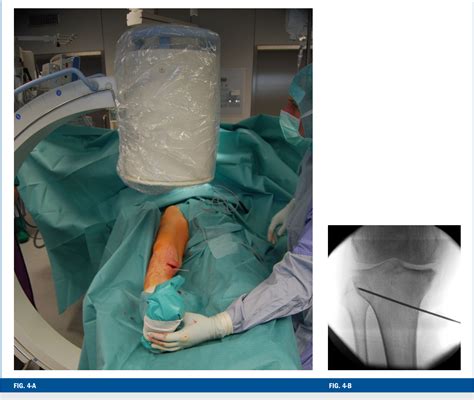 Figure From Opening Wedge High Tibial Osteotomy With A Locked Low