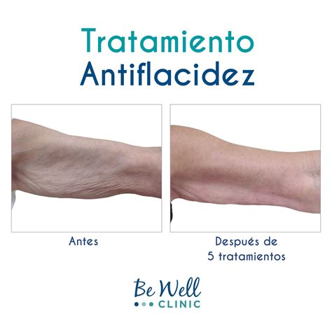 Mesoterapia Antes Y Después Multiesteticamx Multiesteticamx