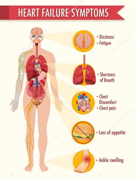 Insuficiencia Cardíaca Síntomas Información Ilustración Infografía