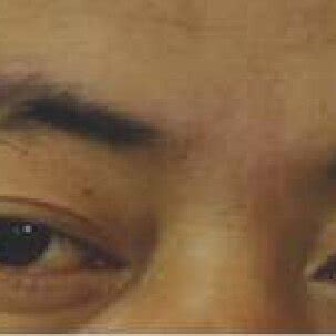 Right Eye Oculomotor Nerve Palsy Resullng In Right Eye Displacement