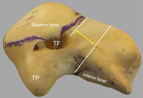 Scanned Image Of The C Vertebra With The Pars Interarticularis