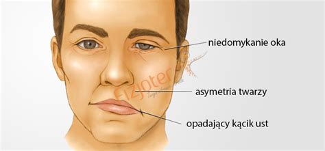 Porażenie nerwu twarzowego przyczyny i postępowanie Fizjoter Kraków