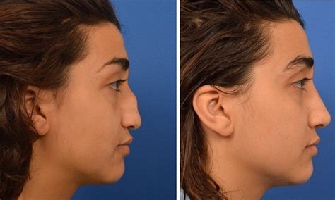 How Much Does A Nose Job Cost With Insurance Detailed Guide