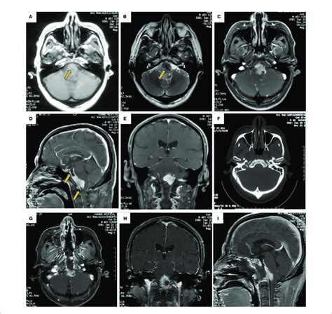 Brain Mri Images Showed Intracranial Mass Located At Middle Of Upper Download Scientific