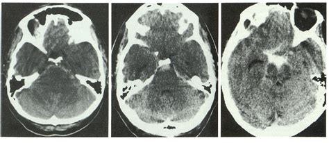 Figure 1 From Nonaneurysmal Perimesencephalic Subarachnoid Hemorrhage