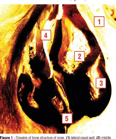 Figure From Endoscopic Endonasal Approach To Pituitary Adenomas