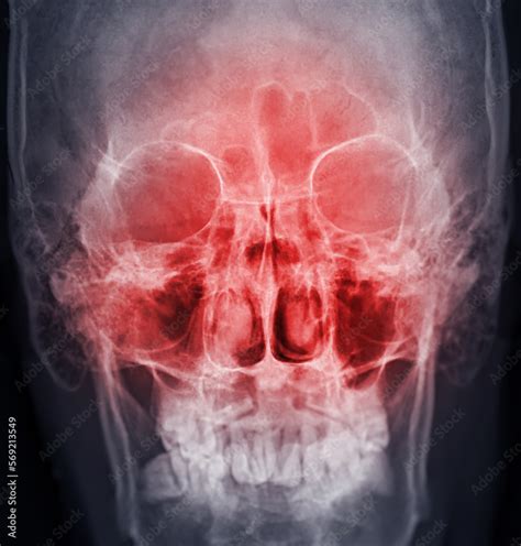 x-ray image of paranasal sinuses for diagnosis sinusitis. Stock Photo ...