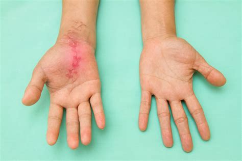 Scars: The healing and treatment process in a nutshell - Alexandria Rehabilitation