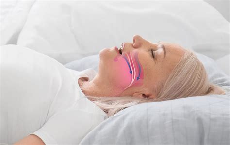 Sleep Apnea Treatment Snoring Disorder German Dental Clinic