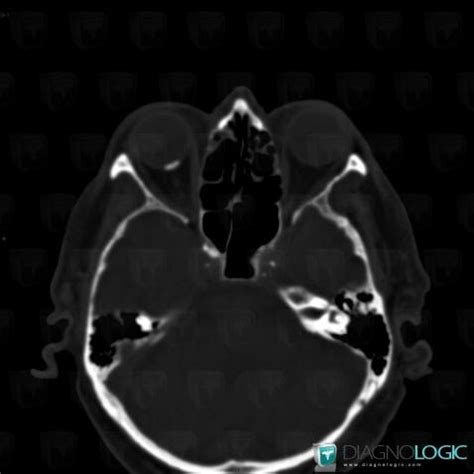 Radiology case : Drusen (CT) - Diagnologic