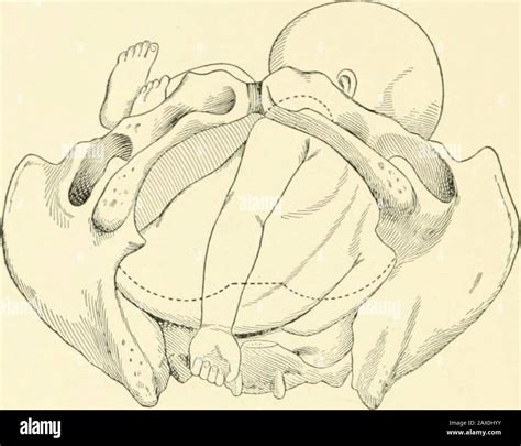 A Textbook Of Obstetrics Fig 250—back Presentationthe Left Arm Is