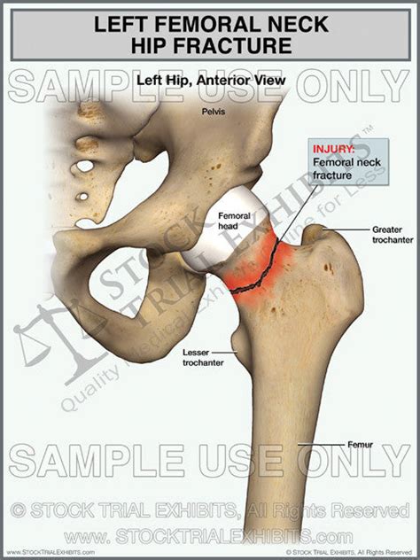 Left Femoral Neck Hip Fracture Stock Trial Exhibits