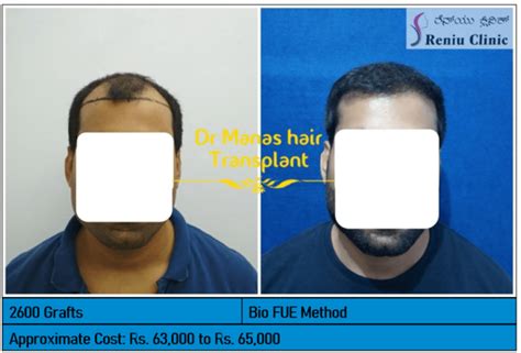 Best Hair Transplant In Mysore Reniu Clinic