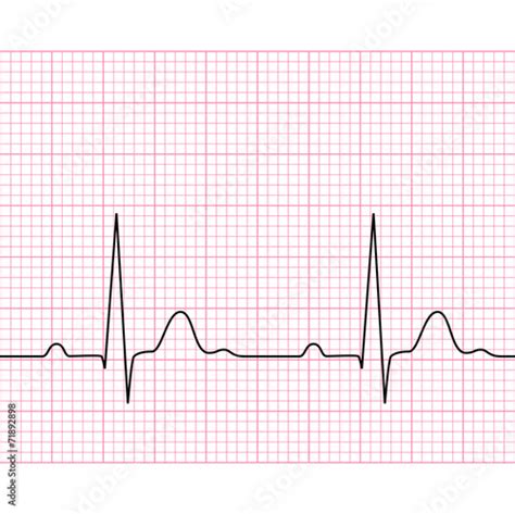 Illustration Of Medical Electrocardiogram Ecg On Chart Paper Comprar