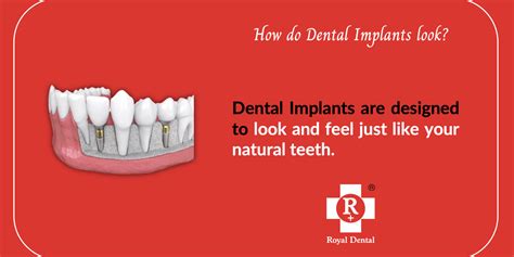 How To Make Your Dental Implant Sustainable Royal Dental Clinics Blog