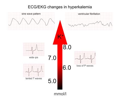 Hyperkalemia Ecg Changes Barehrom The Best Porn Website