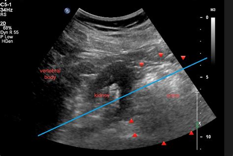 Ultrasonographic Detection Of Retrorenal Colon In Prone Position An