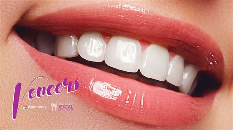 Composite Porecelian Veneers Nerang Veneers Gold Coast Dentist