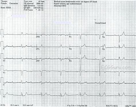 Instructors Collection Ecg Of The Week Complete Av Block With Junctional Escape Rhythm