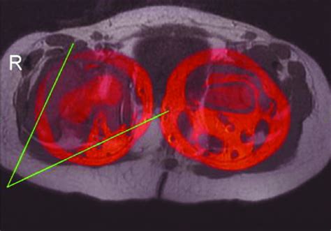 Fused Axial T1 Weighted Fse Mri Sequence Showing The Lines Employed For