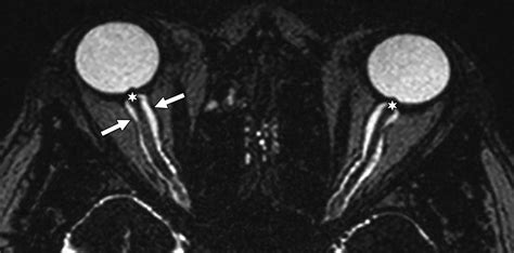 Papilledema Mri