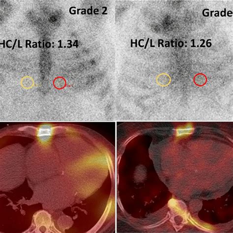 Typical Echocardiographic Features Of Cardiac Amyloid Involvement