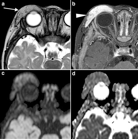 A 6 Month Old Girl With Hemangioma A Axial T2 Weighted Image Shows A