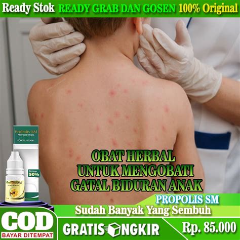 Jual Obat Gatal Biduran Anak Obat Biduran Yang Aman Untuk Anak Obat