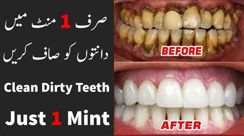 Easy Way To Clean Dirty Teeth In Just 1 Mint 100 Cleaning Teeth